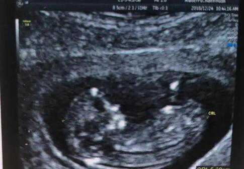 福州哪里助孕机构 2023
福州总院可以做供精试管吗？ ‘一个月b超单看男女’